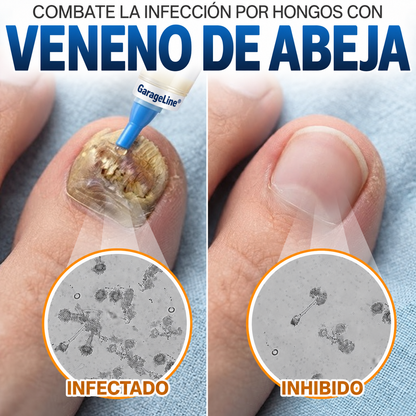 GarageLine® Tratamiento para Uñas con Veneno de Abeja Contra Hongos