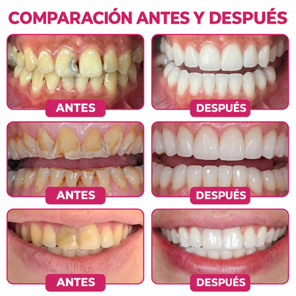 HEATWOLF® DenPerm Gel Rellenador Natural de Esmalte para Reparar Caries
