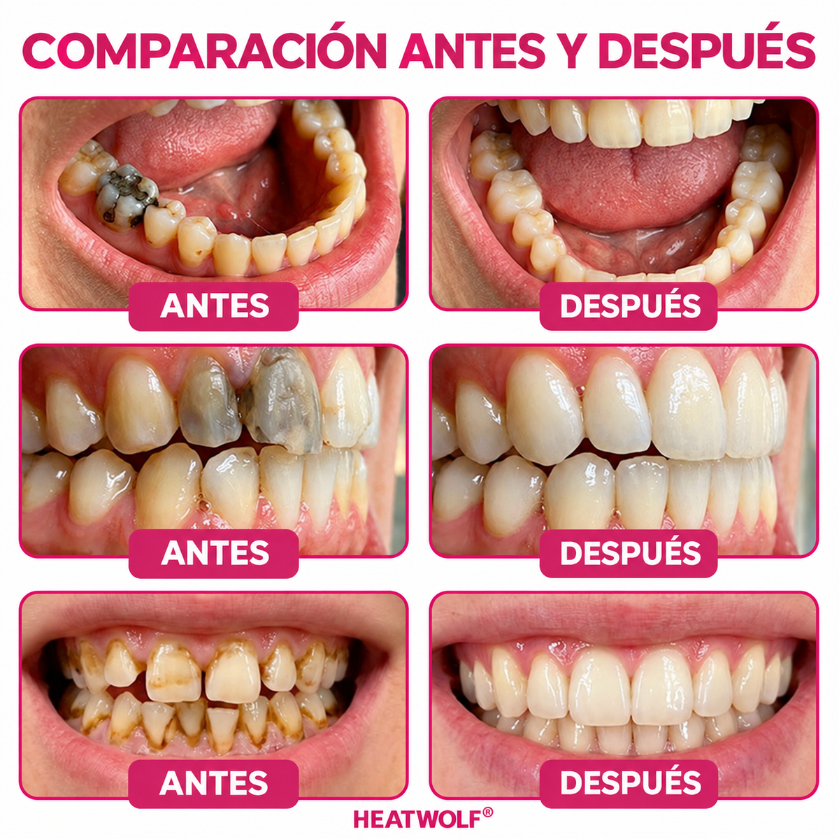 HEATWOLF® DenPerm Gel Rellenador Natural de Esmalte para Reparar Caries